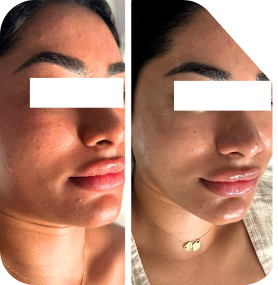 Acne hydrafacial in Malak Skincare