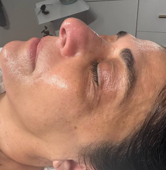 Hydrafacial