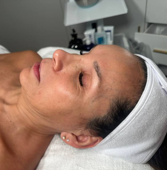 Microneedling