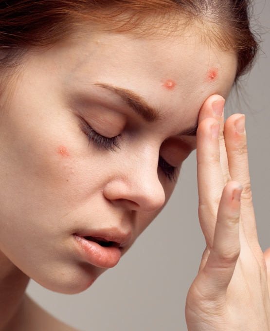 Acne Relief Hydrafacial