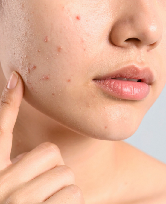 Acne Face acne and scar